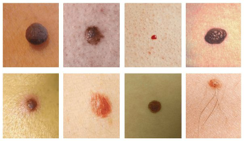 The most common spots on the skin is a mole and the human papillomavirus (warts)