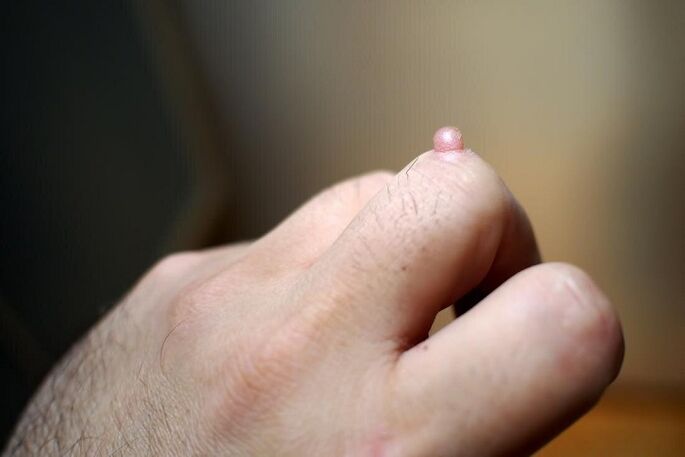 Warts on fingers