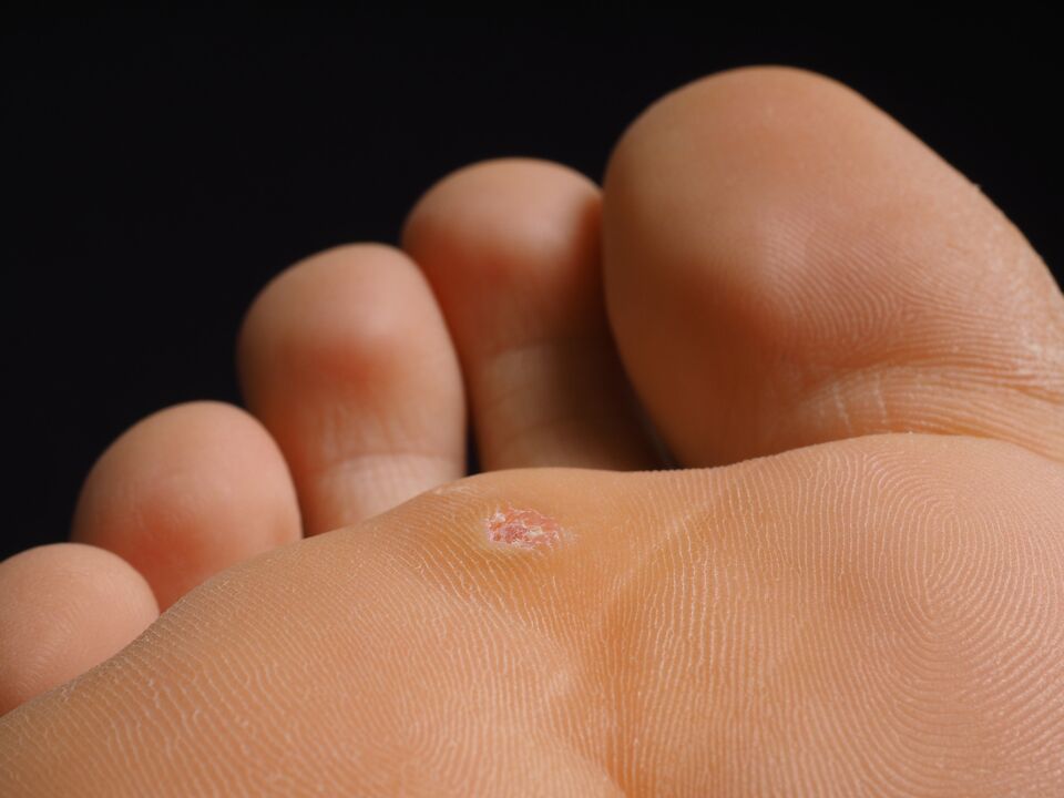 What does plantar wart look like 