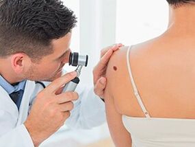 The doctor examines the papilloma and recommends drug removal