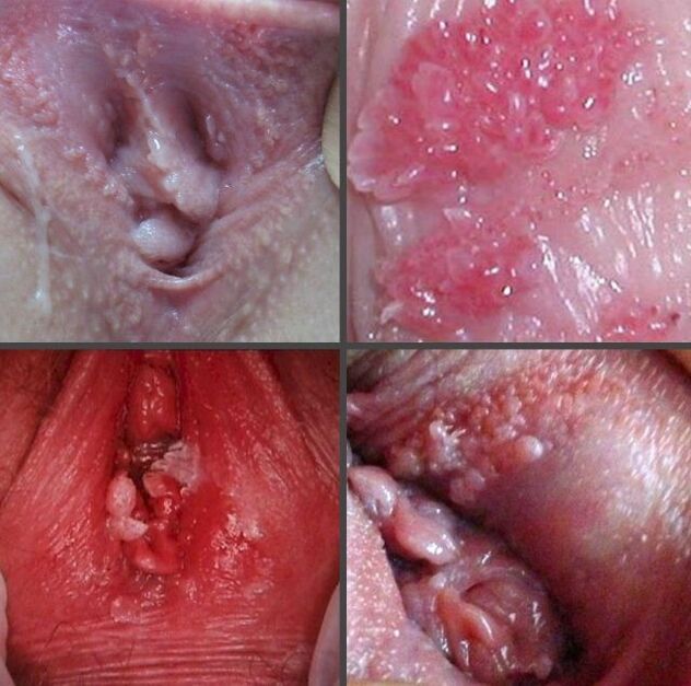 Close up of papilloma in vagina
