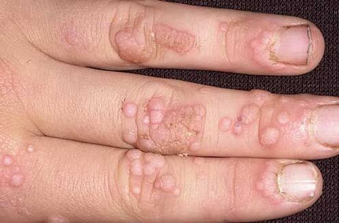 How to Get Rid of Warts on Your Hands