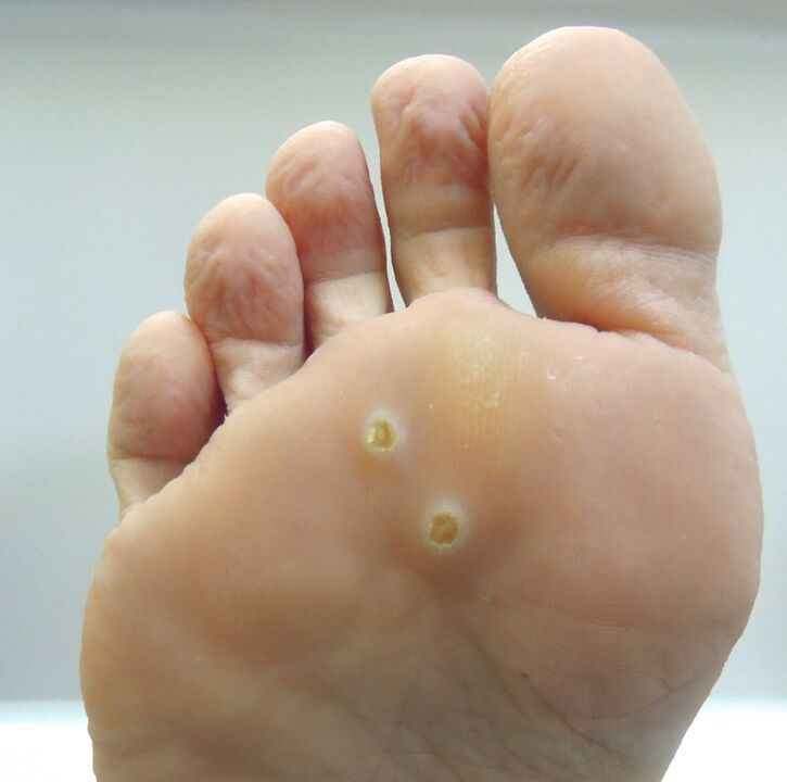 How to Remove Warts from Your Feet