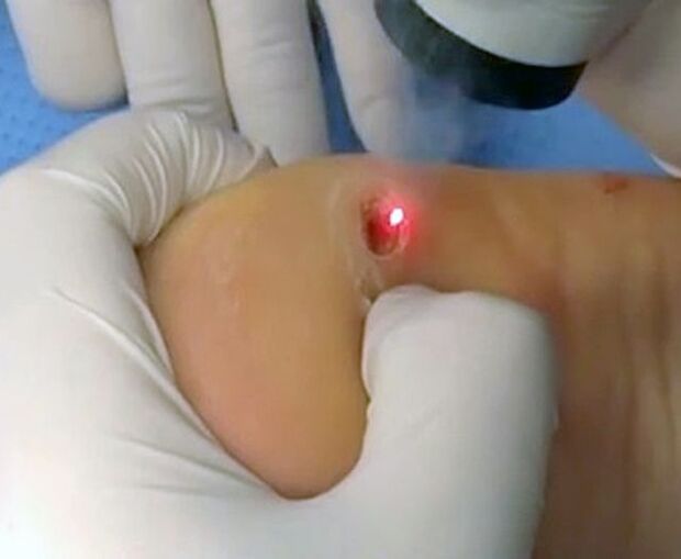 Process of removing heel warts using laser