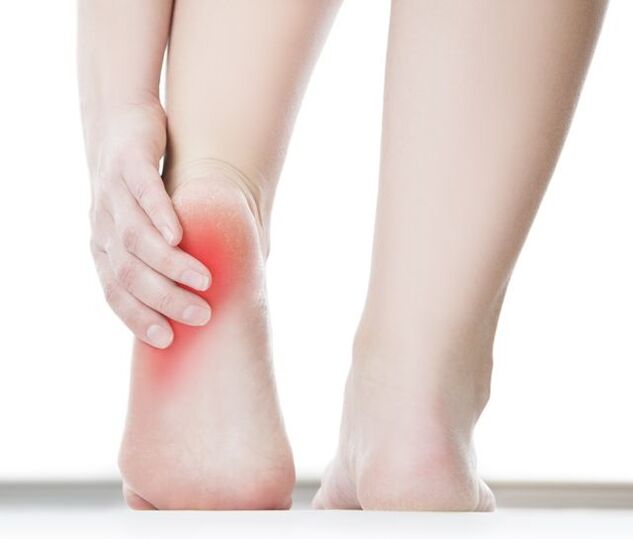 Warts on heels can cause severe pain