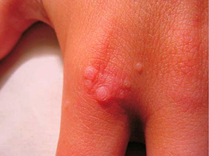 How to get rid of small papilloma
