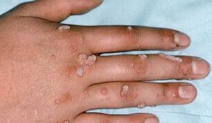 Types of warts and how to remove them