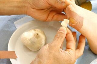 Garlic hot compress to treat papilloma